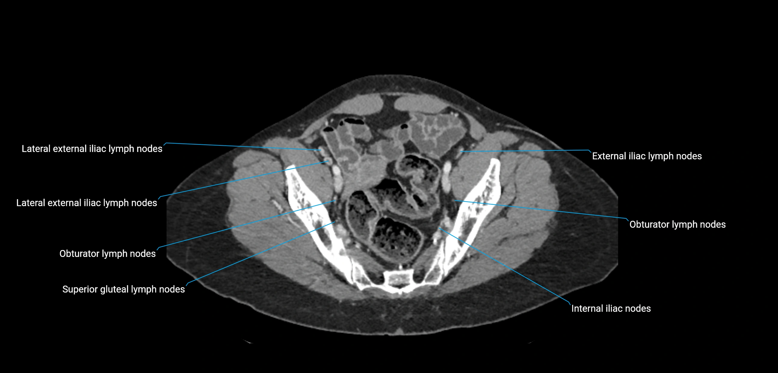 CT ct abdominal lymph nodes  axial cross sectional anatomy  enchanced radiology image -img-00002-00354.webp